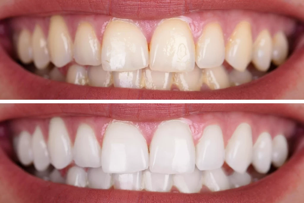 سفید کردن دندان با استفاده از مواد بلیچینگ