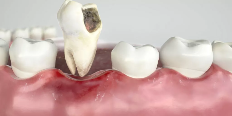 درد دندان بعد از کشیدن
