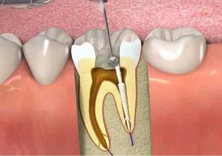 درد دندان به عصب رسیده چه مشخصاتی دارد