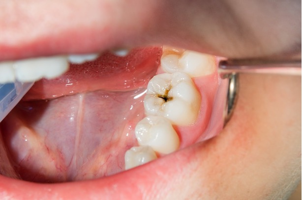 چکاپ جهت بررسی پوسیدگی دندان