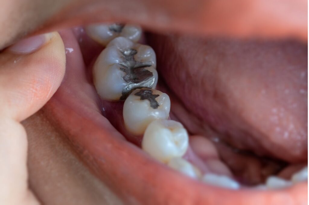 درد دندان پر شده بعد از برداشت پوسیدگی