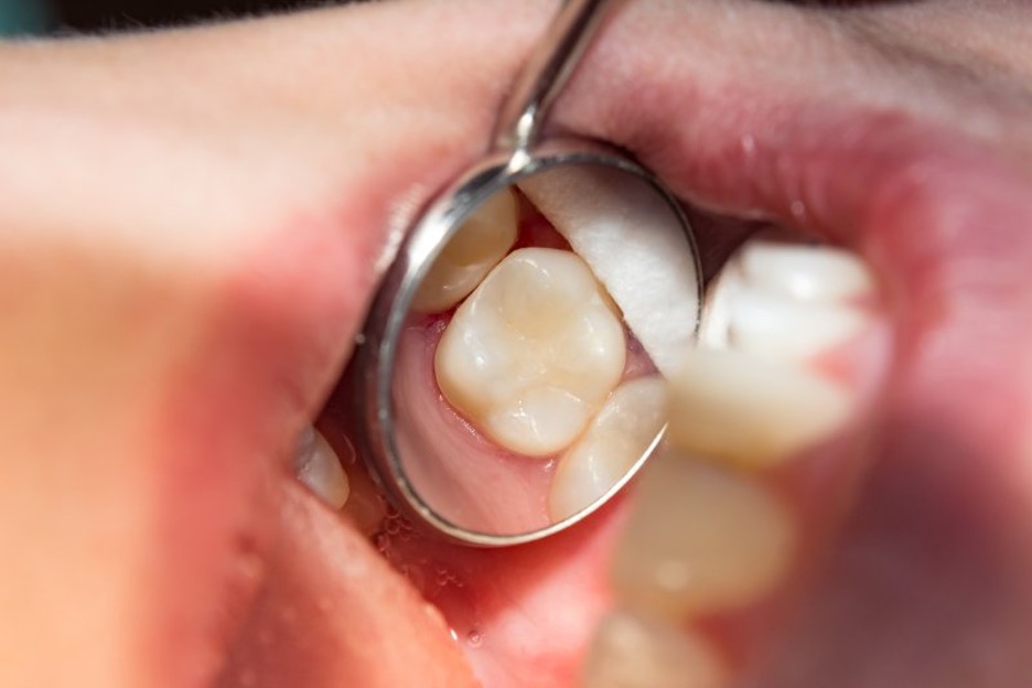بررسی علت های درد دندان پر شده