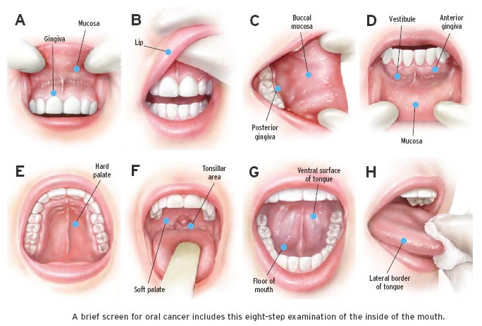 نشانه های سرطان دهان