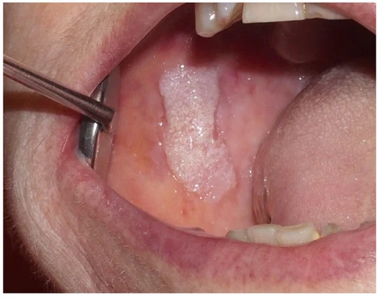 عکس سرطان دهان در سطح باکال سمت راست