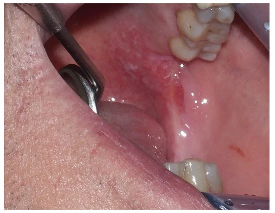 عکس تشخیص سرطان دهان