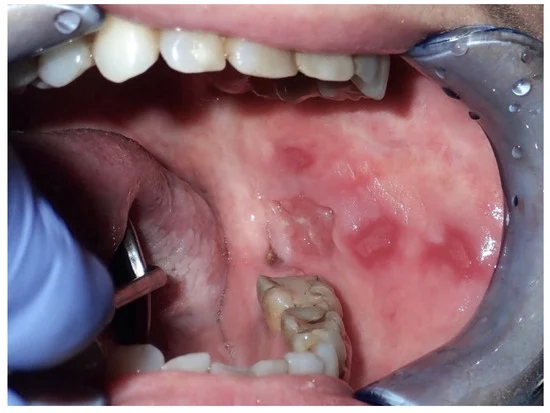 عکس تشخیض سرطان دهان