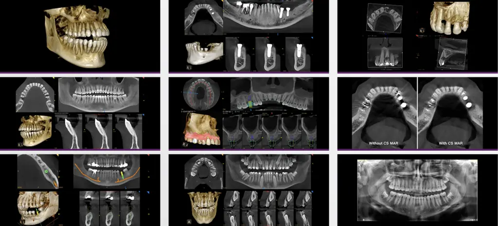نمونه عکس CBCT جهت تشخیص طول استخوان ها جهت کاشت ایمپلنت دندانی