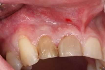 بیمار با شکایت از درد ناشی از تغییر رنگ دندان لترال سمت راست مراجعه کرد.