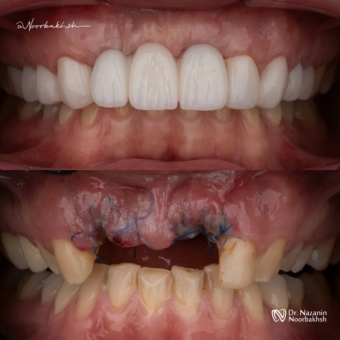 تصاویر کاشت ایمپلنت دندانپزشکی نوربخش