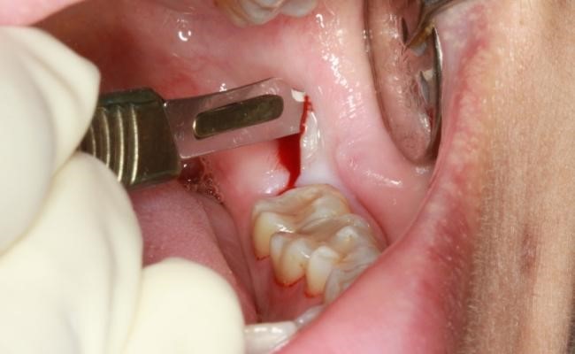 پروسه جراحی دندان عقل