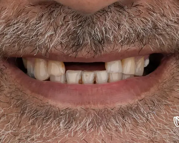 کاشت ایمپلنت دندان