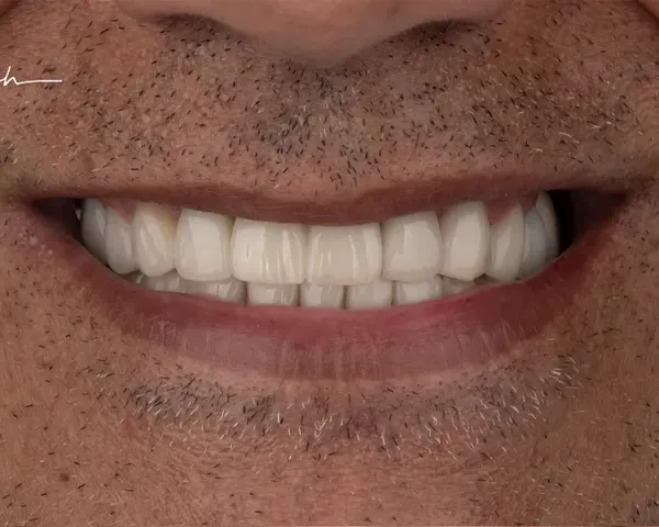 کاشت ایمپلنت دندان
