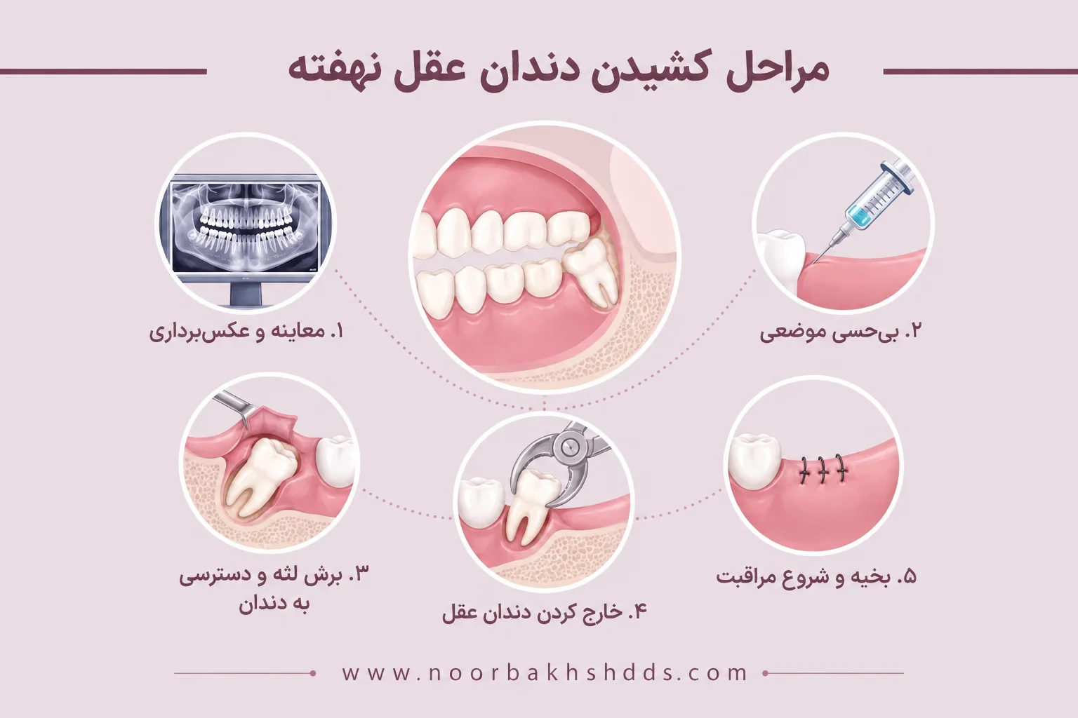 مراحل کشیدن دندان عقل