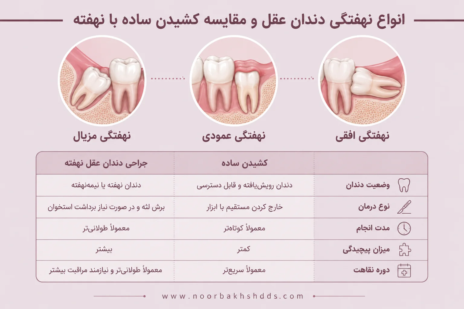 انواع نهفتگی دندان عقل
