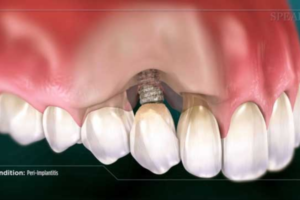 علل احتمالی پس زدن ایمپلنت دندانی