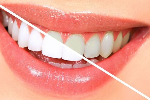 سفید کننده های دندان و انواع آن