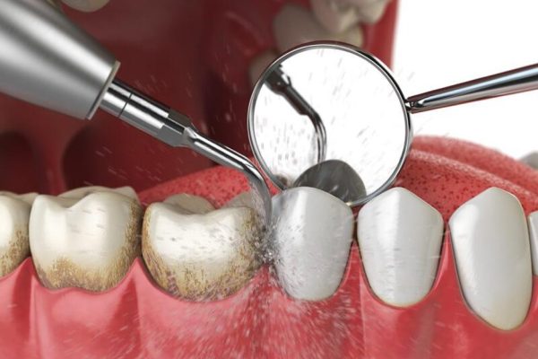 دلایل شکل گیری جرم دندان