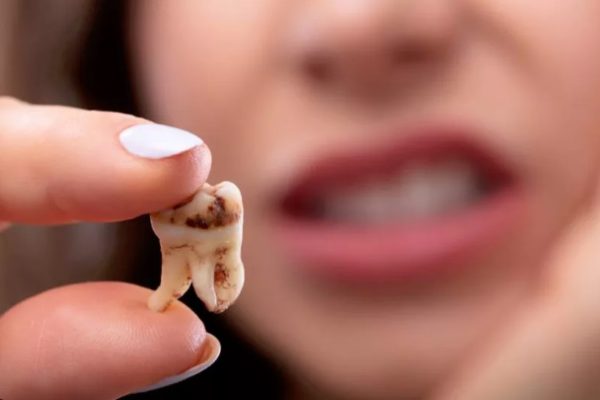 علت درد بعد از کشیدن دندان عقل
